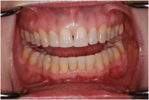 invisalign after 3