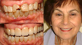 North-York-dentist-before-and-after